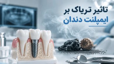 تأثیر تریاک بر ایمپلنت دندان و خطرات دود تریاک برای سلامت ایمپلنت