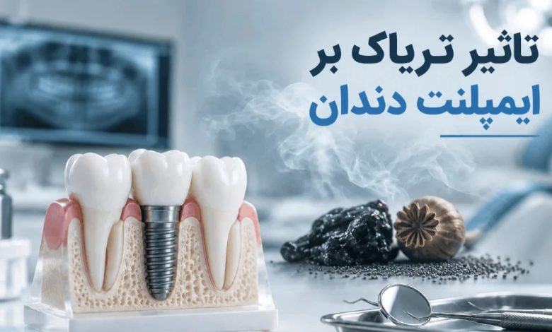 تأثیر تریاک بر ایمپلنت دندان و خطرات دود تریاک برای سلامت ایمپلنت
